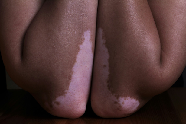 The Benefits of Seeking Treatment at a Vitiligo Clinic in Singapore